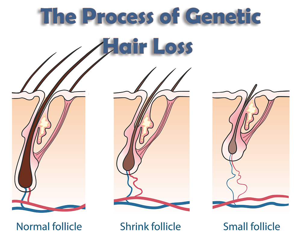 The Process of Genetic Hair Loss