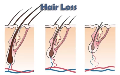 The Process of Genetic Hair Loss